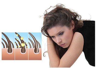 مشكلة «قشرة فروة الرأس» Dandruff